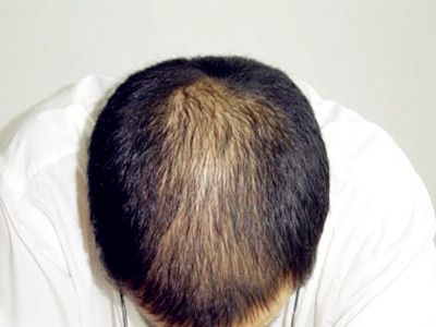男人经常掉头发是肾虚吗
